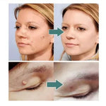 FormuClear™ - Elimina verrugas sin dolor y seguro + ENVIO GRATIS
