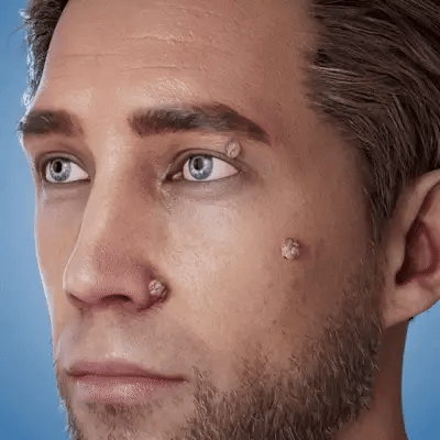 FormuClear™ - Elimina verrugas sin dolor y seguro + ENVIO GRATIS