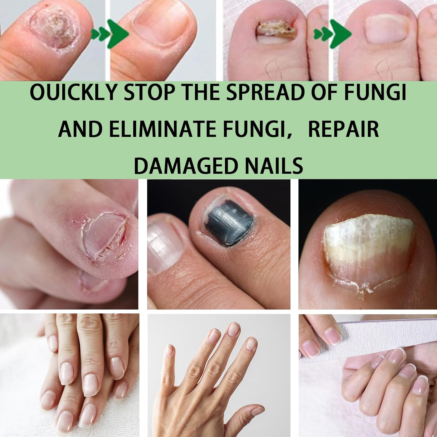 Dile adiós a los hongos en 7 días | Aceite Milagroso para Uñas